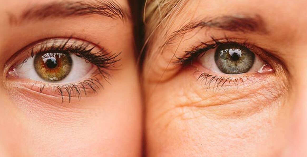 Внешние признаки старения кожи вокруг глаз у двух женщин разного возраста